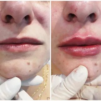 Preenchimento Labial